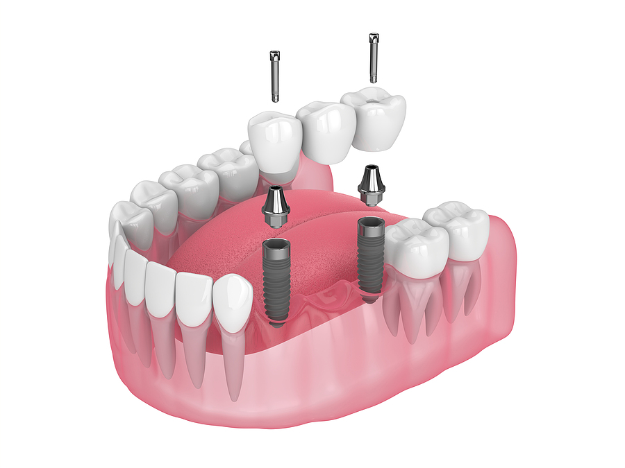 The Process of Getting a Dental Bridge