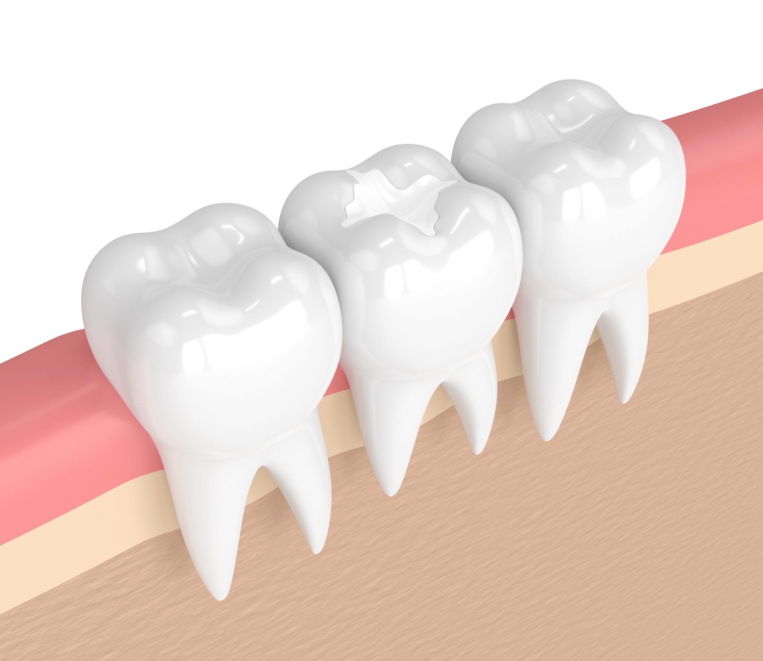 The Benefits of Composite Fillings